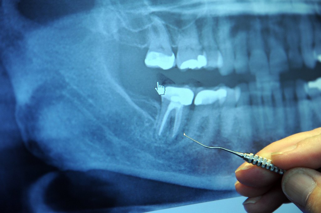 abscessed tooth drainage